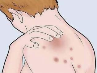 健康护航丨湿疹不可怕 科学护理是关键