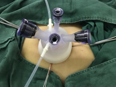 梅州市中医医院开展经脐单孔腹腔镜术治疗巨大子宫肌瘤