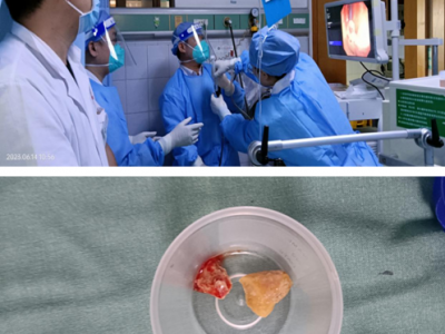 兴宁市人民医院呼吸与危重症医学二科利用电子气管镜下成功巧取异物