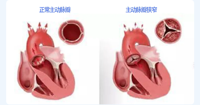 主动脉的三个瓣膜图片图片