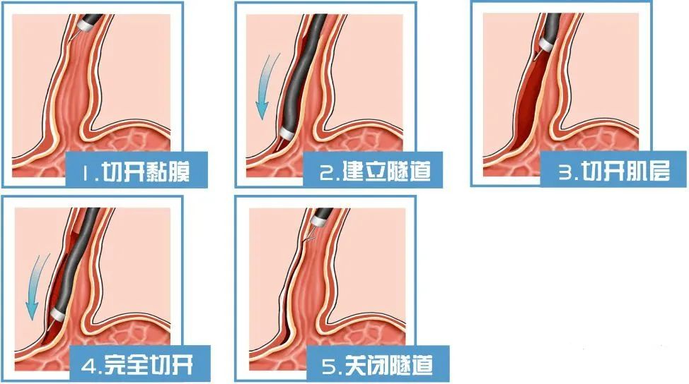 幽门环肌切开术示意图图片