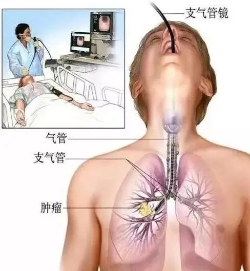 呼吸介入治疗专家郭俊华:"打通"气道,重获畅快呼吸_掌上梅州
