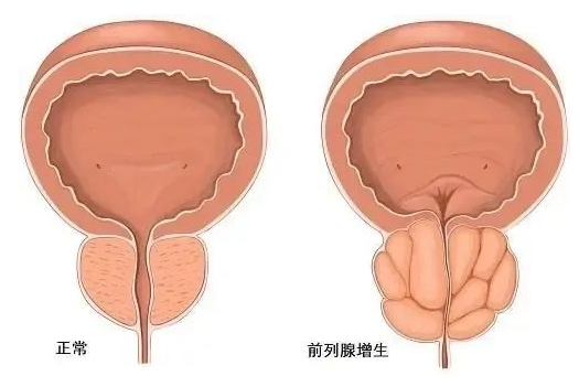 良性前列腺增生俗称前列腺肥大,由于前列腺间质和腺体成分的增生,导致