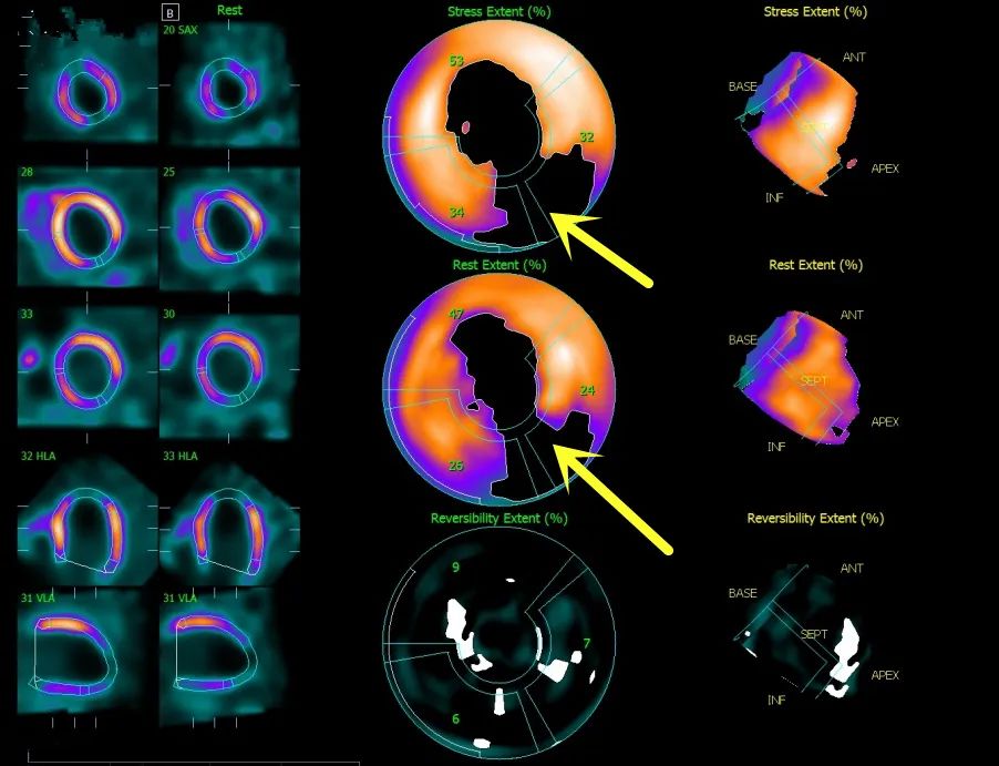广东首台心脏专用ectdspect亮相梅州硬核技术看透心世界