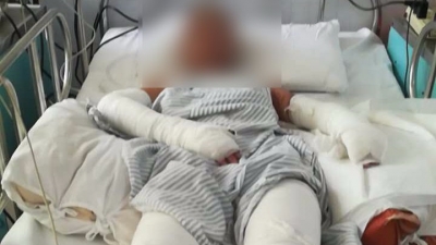 揪心！五华一户人家煤气泄露爆炸起火，姐妹俩严重烧伤…