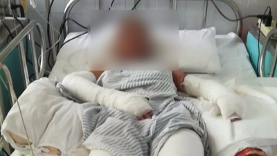张晨看望慰问五华煤气爆炸事故烧伤的婆孙三人