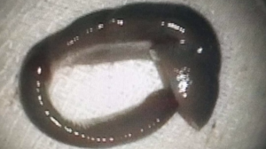 平远男子鼻出血一个多月，竟是水蛭入鼻！这种做法要警惕了