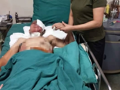 电烧伤，眼失明...这位水电师傅遭遇意外，你能帮帮他吗？