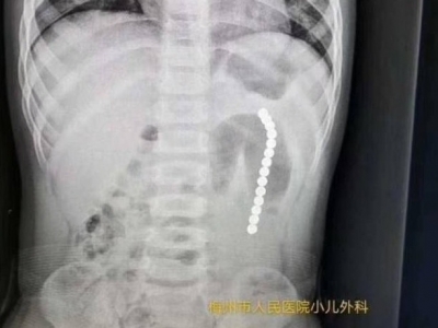扎心！梅州2岁孩童误食磁力珠致胃肠穿孔，别让孩子玩了！