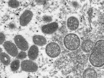 世卫组织：非洲猴痘疫情不再构成“国际关注的突发公共卫生事件”