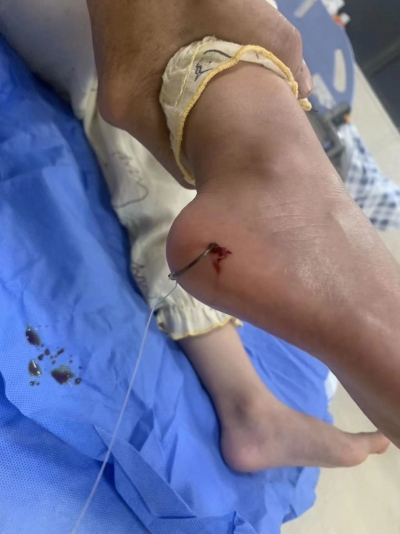 梅城一女童在江边散步，脚竟被鱼钩钩住