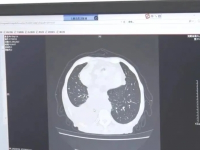 感染甲流可能引起“白肺”吗？专家解答