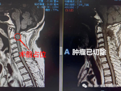 大埔县人民医院成功实施脊髓神经鞘瘤切除术