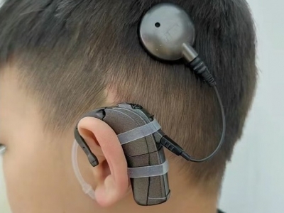 人工耳蜗集采在梅州落地，单套价格降至5万元左右！