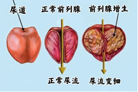 中山三院粤东医院团队开展经尿道前列腺半导体激光剜除术，为患者解除“男”言之隐
