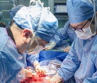 中山大学附属第三医院粤东医院：多学科团队成功完成腹腔巨大肿瘤切除手术