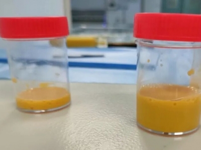 揪心！梅州新生宝宝患上罕见病，中山大学附属第三医院粤东医院科学救治引出“奶茶样”液体